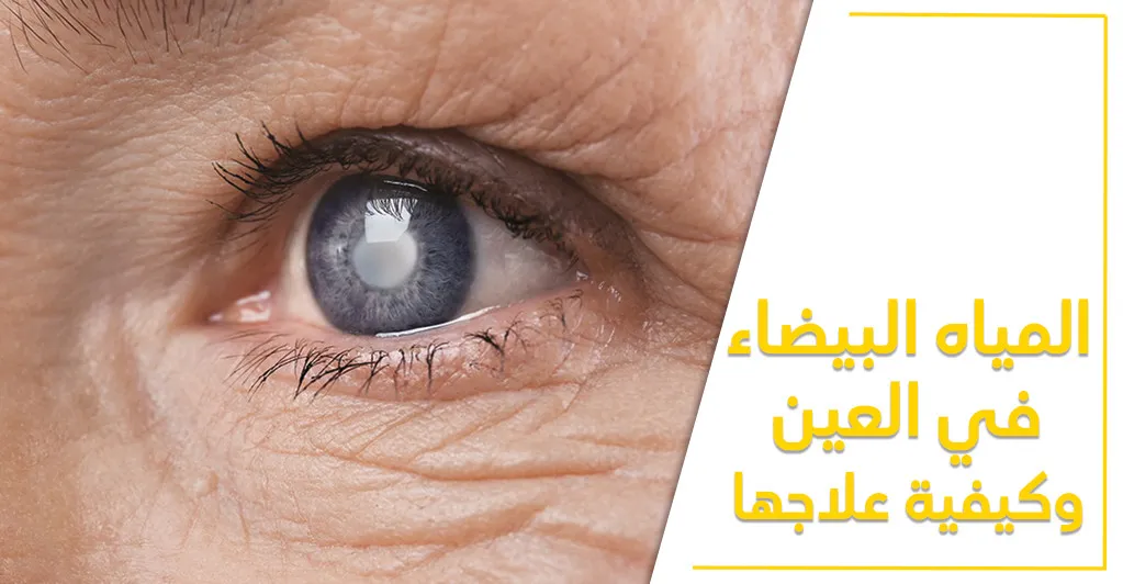 المياه البيضاء في العين وكيفيّة علاجها